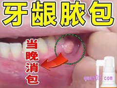 美团牙龈脓包牙根发炎肿包肿痛消炎牙根疼鼓包上火牙炎根周止痛药喷剂